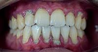 التهاب النسج الداعمة للأسنان