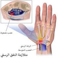  متلازمة النفق الرسغي 