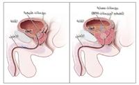 أمراض البروستاتا وأسبابها وأعراضها