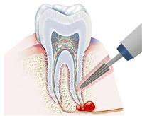 كيس الأسنان: الأسباب والأعراض وطرق العلاج