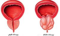 التصوير بالاشعة لسرطان البروستات غالباً لا تلزم