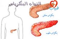 التهاب البنكرياس الحاد: أسبابه وأعراضه وتشخيصه