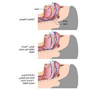 علاج الشخير ..