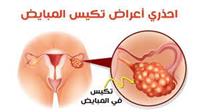  تكيس المبايض: الأعراض والعلاج. 