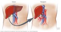 عملية زراعة الكبد