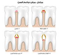 التهاب اللثة