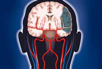 نصائح للوقاية من الجلطات الدماغية