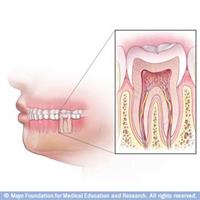 علاج الجذور وأعصاب الأسنان