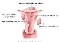 الورم الليفي في الرحم