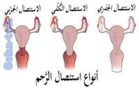  استئصال الرحم ..