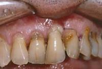  التهاب النسج الداعمة للأسنان 