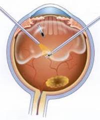 عملية استئصال زجاجية العين