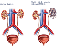  العيوب والتشوهات الخلقية للكلى