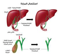 إستئصال المرارة