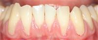 كيف يتم علاج تعري جذور الأسنان