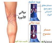 علاج دوالي الساقين بالليزر دون تدخل جراحي