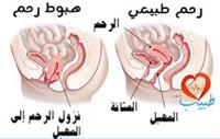 هبوط الرحم