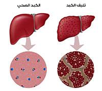 علاج تليف الكبد وكيف يتم ذلك؟