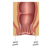 الناسور في فتحة الشرج