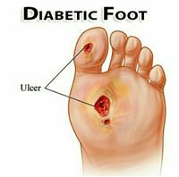  أعراض القدم السكرى أهمها تلون الجلد ووخز مؤلم 