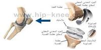  استبدال مفصل الركبة .