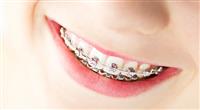 اعادة تقويم الأسنان: التيجان أم زراعة الاسنان؟