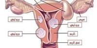 الأورام الليفية الرحمية.