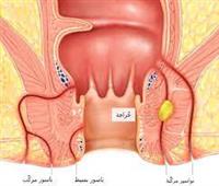 الناسور الشرجي واسباب الاصابة به