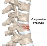 هشاشة وليونة العظام قد تخلف كسوراً انضغاطية 