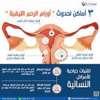 3 أماكن لحدوث أورام الرحم الليفية