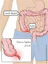 استئصال الزائدة الدودية عند الأطفال