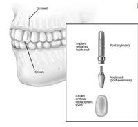 كيف تتم جراحة زراعة الأسنان