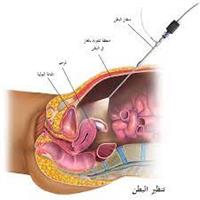 تنظير الرحم.