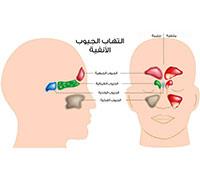  التهاب الجيوب الأنفية. 