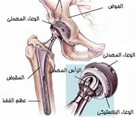 استبدال الورك