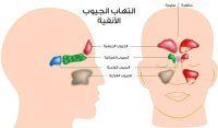 التهاب الجيوب الانفية المزمن