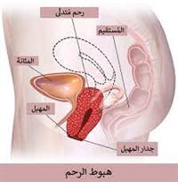 تدلي الرحم