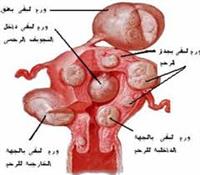 الورم الليفي في الرحم