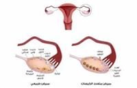 اورام المبيض الخبيثة