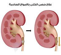  تفتيت حصى الكلى. 