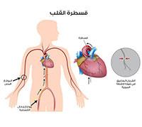  قسطرة القلب. 