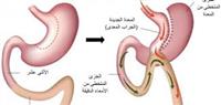 النِّظام الغذائيّ بعدَ جِراحة المجازة المِعَدِيَّة