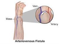  النَّاسورُ الشِّريانِي الوَريدِيّ Arteriovenous 