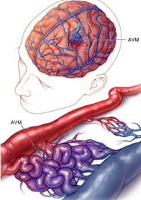 التشوه الشرياني الوريدي الدماغي