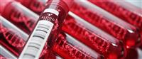 أمراض الدم الوراثية: تعرف على أبرزها ...