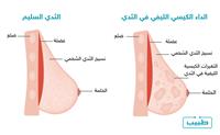  التغيراتُ الكيسيَّة الليفية في الثَّدي 