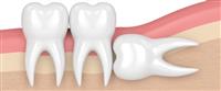 ضرس العقل المدفون: معلومات هامة 