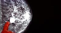 التكنولوجيا المتقدمة والاكتشاف المبكر لسرطان الثدي