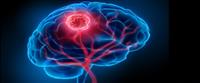  أعراض ورم الدماغ الحميد وكيفية تشخيصه 