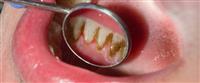 مضاعفات تسوس الأسنان: تعرف عليها ,,,,,,,,